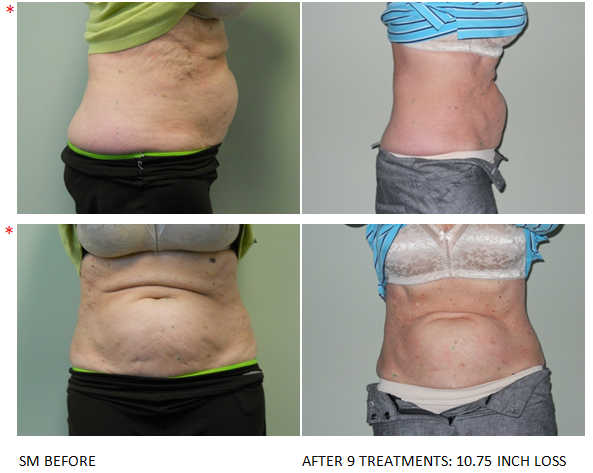 Led light fat reduction and contouring: Before & After #1