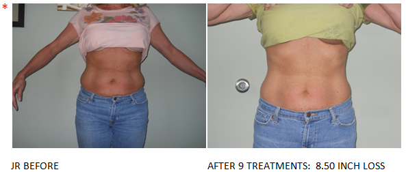 Led light fat reduction and contouring: Before & After #2