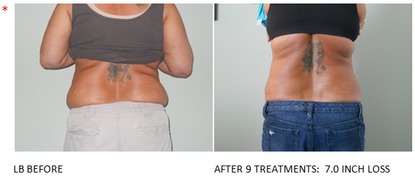 Led light fat reduction and contouring: Before & After #3