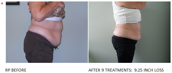 Led light fat reduction and contouring: Before & After #4