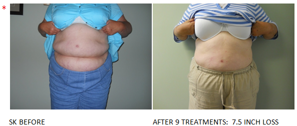 Led light fat reduction and contouring: Before & After #5