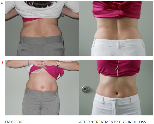 Led light fat reduction and contouring: Before & After #6